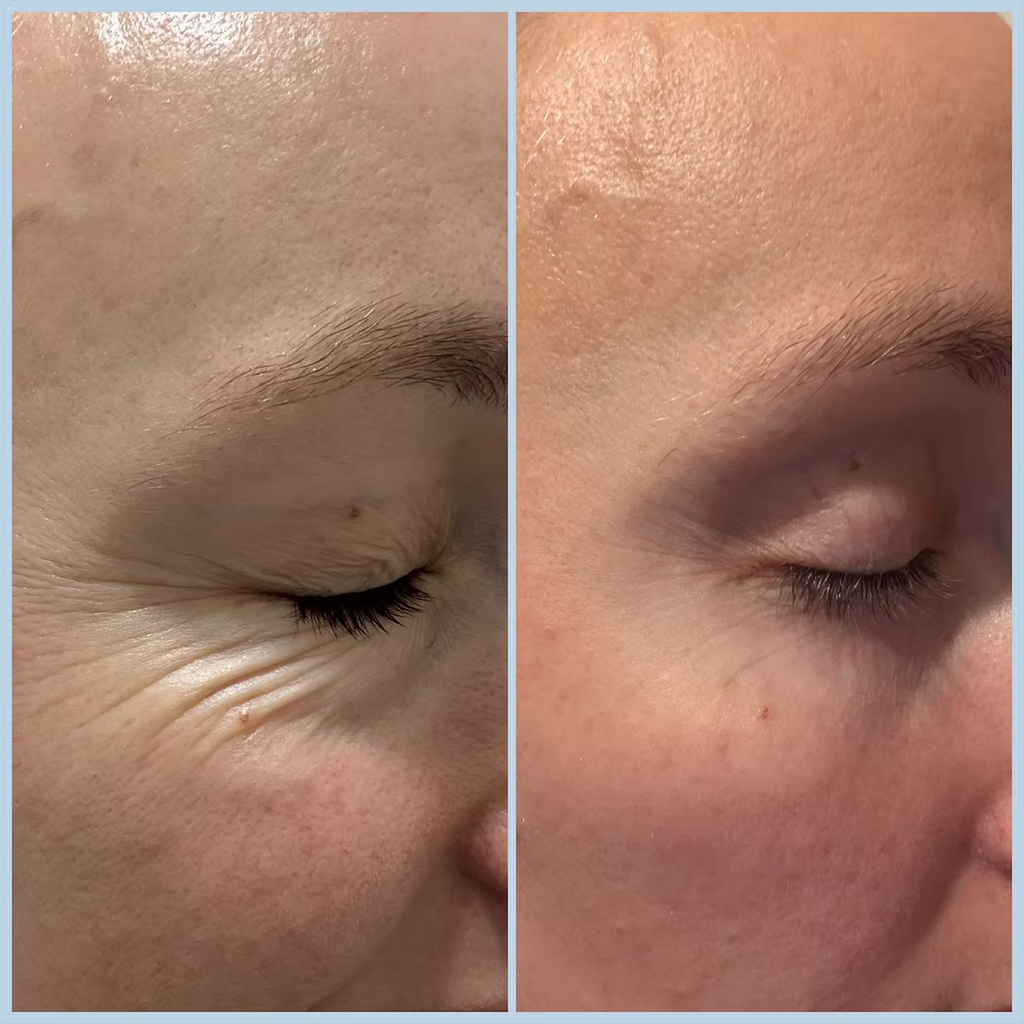 My Wrinkles Forever Eye Patches