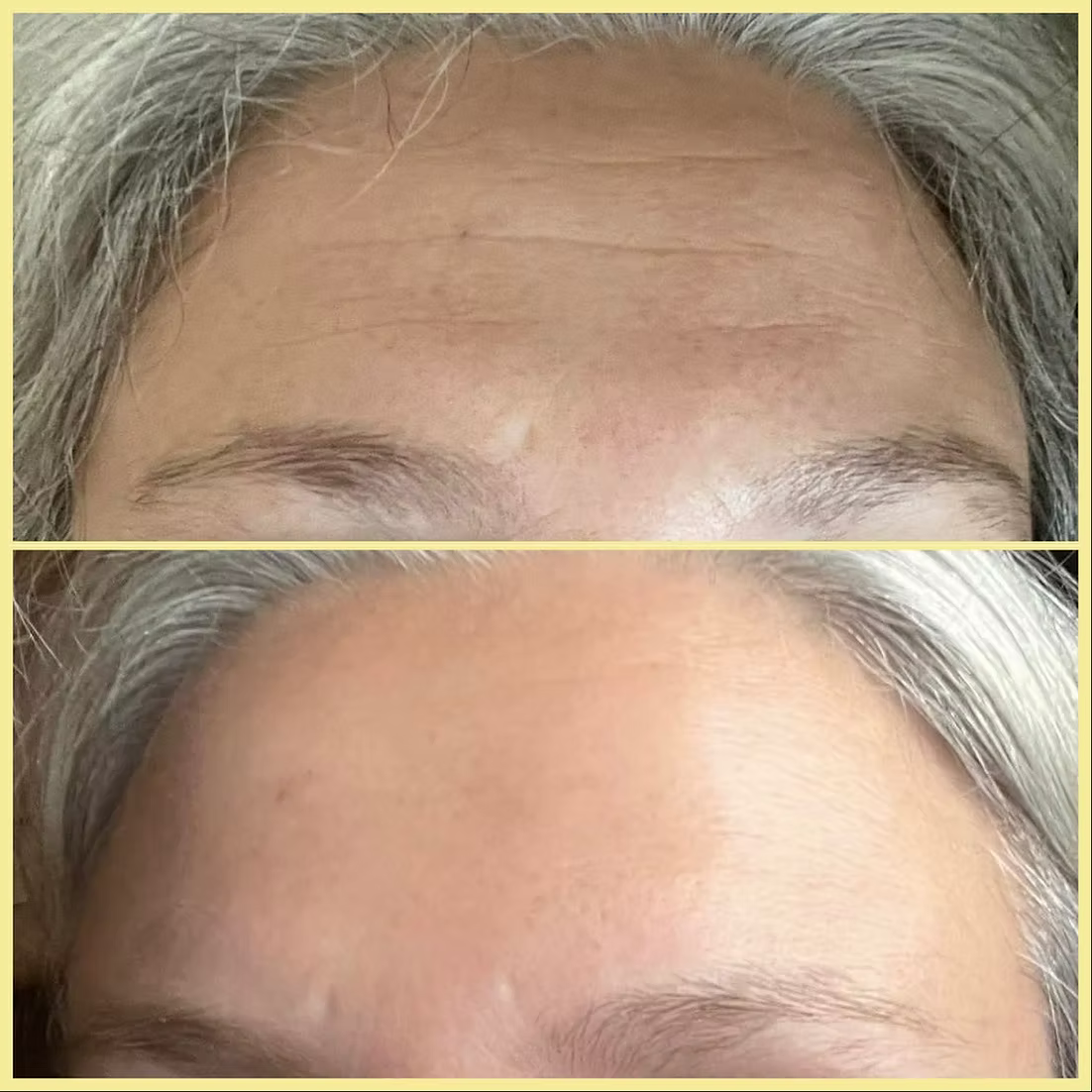 My Wrinkles Forever Forehead Patches
