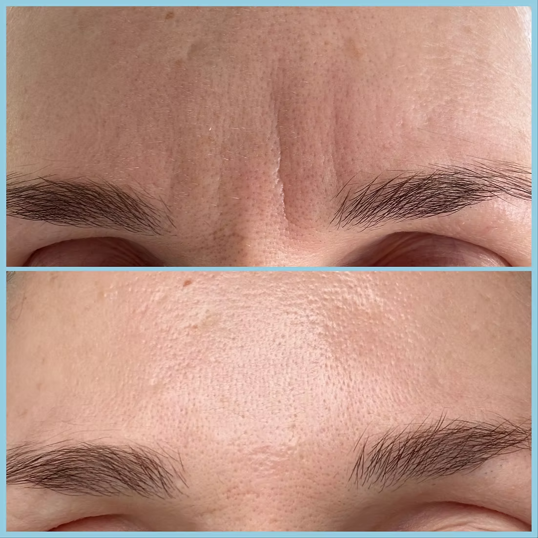My Wrinkles Forever Forehead Patches